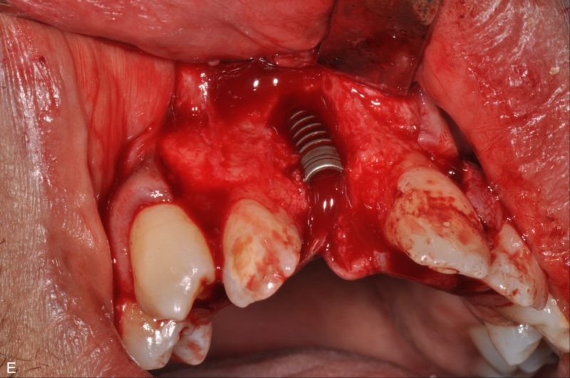 Use Of T-barrier Titanium Membrane And Regenerative Materials In Frontal Site
