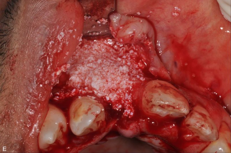 Use Of T-barrier Titanium Membrane And Regenerative Materials In Frontal Site