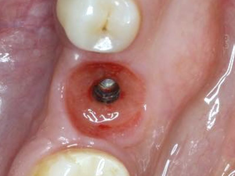 Single Implant Restoration – Prosthetic Steps