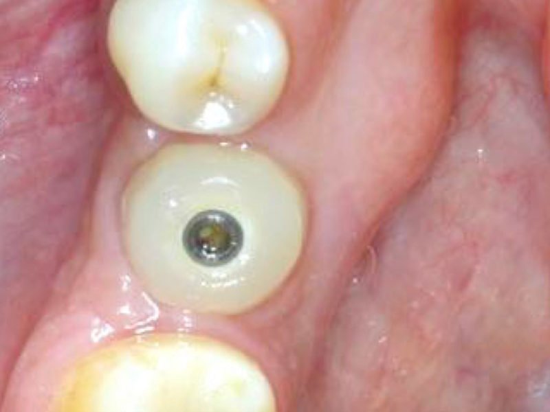 Single Implant Restoration – Prosthetic Steps 2