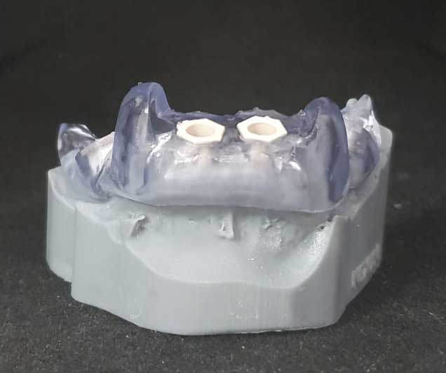 Implant Insertion With Enhanced Offset In Guided Surgery, laita balda kit 2