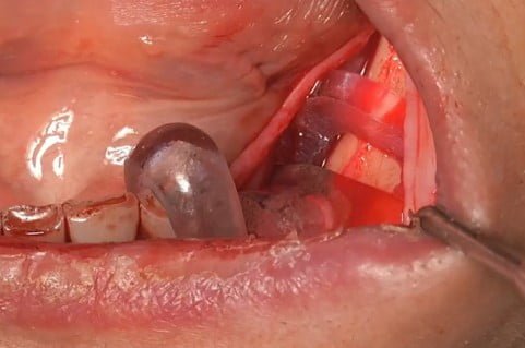 Bilateral Subperiosteal Customized Implants On Atrophic Mandible