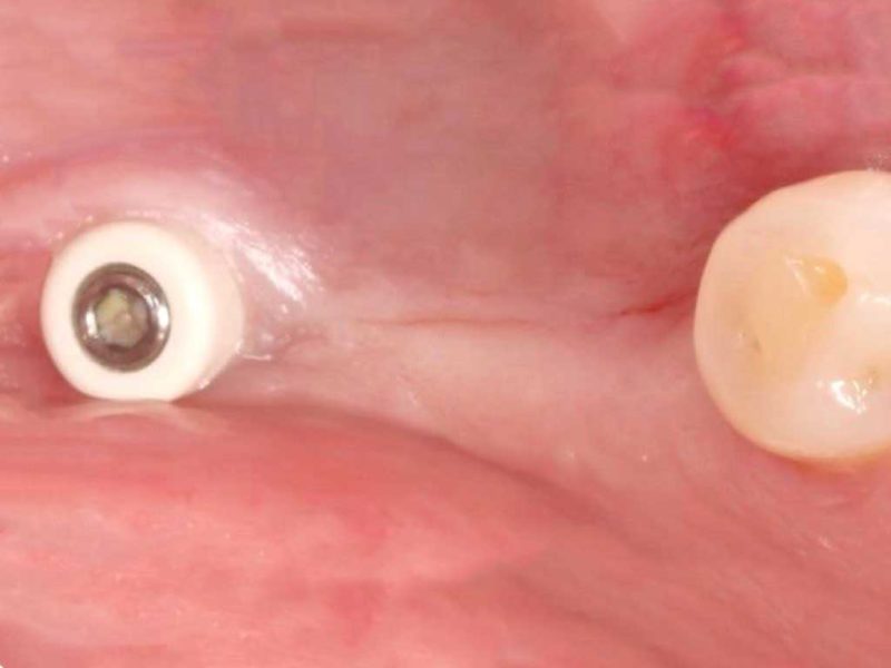 Free Saddle Restoration With Ev Implant Line