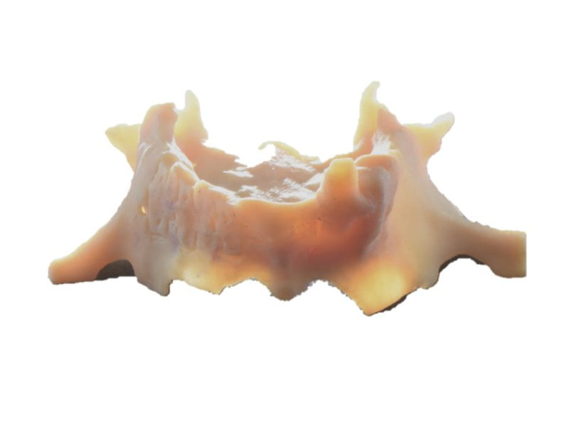 Subperiosteal Customized Implant On Atrophic Maxilla