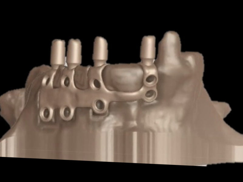 Subperiosteal Customized Implant On Atrophic Maxilla