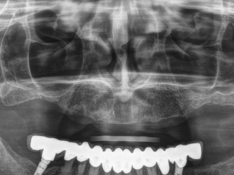 All On Four On Mua With Guided Surgery