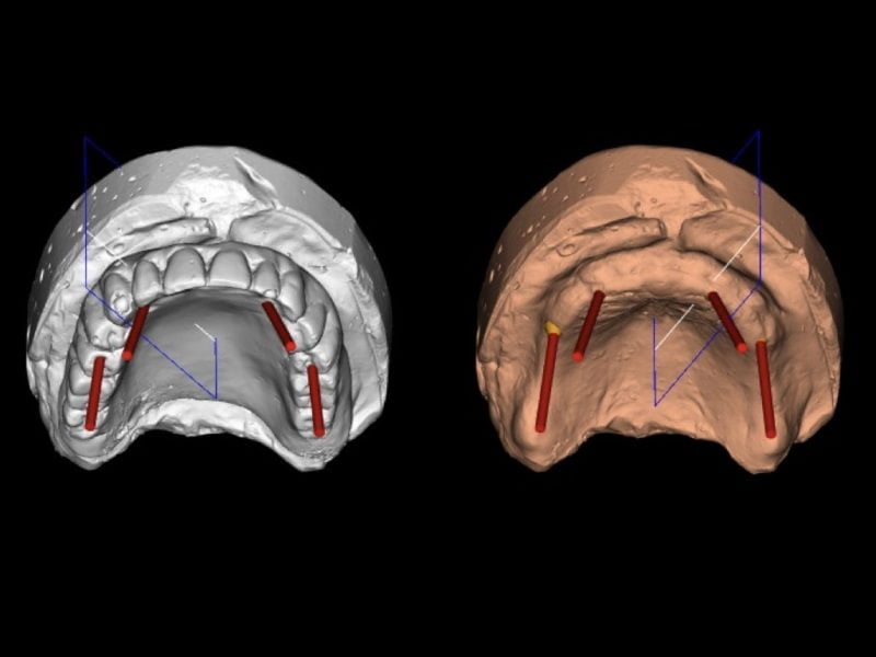 All On Four On Mua With Guided Surgery