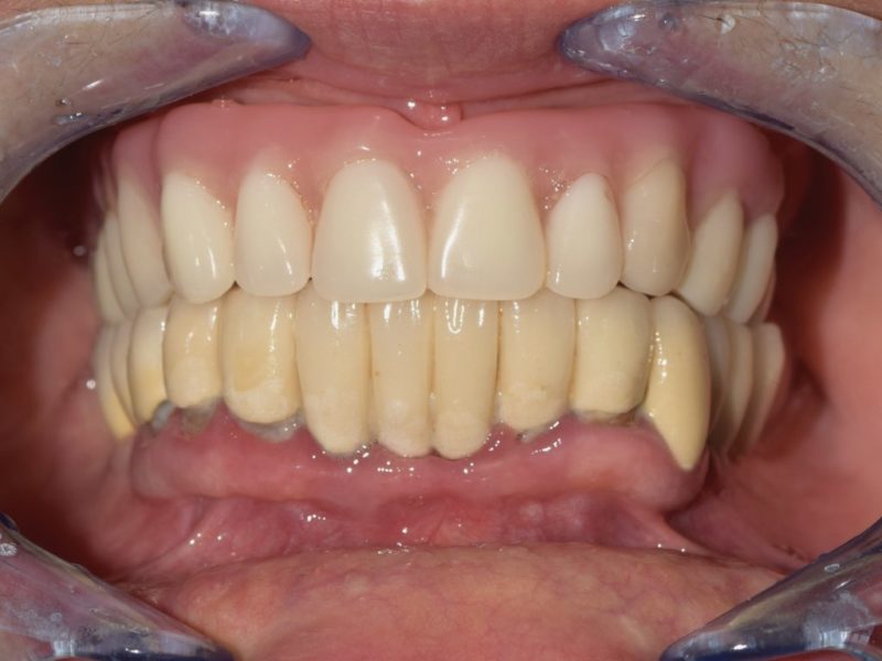 All On Four On Mua With Guided Surgery