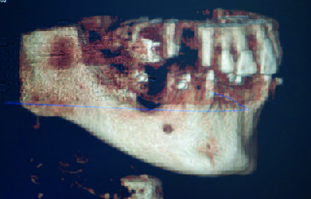 Full Arch Immediate Load Case With Osteoplasty 2