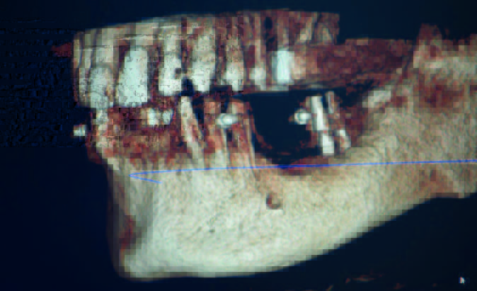 Full Arch Immediate Load Case With Osteoplasty