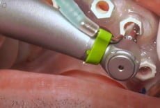 All-on-6 With Guided Surgery 2