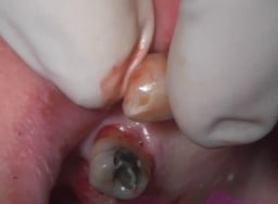 4 Implants Guided Surgery With Extractions And Immediate Loading