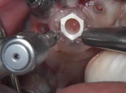 4 Implants Guided Surgery With Extractions And Immediate Loading