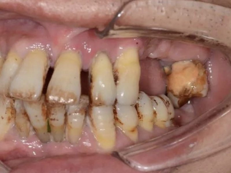 Difficult Maxilla Implant Insertion With Mua Supported Prosthesis
