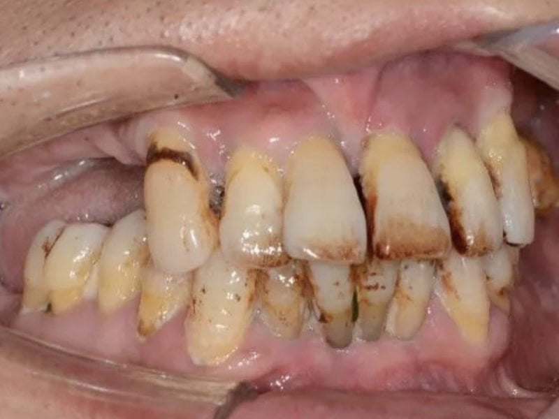 Difficult Maxilla Implant Insertion With Mua Supported Prosthesis