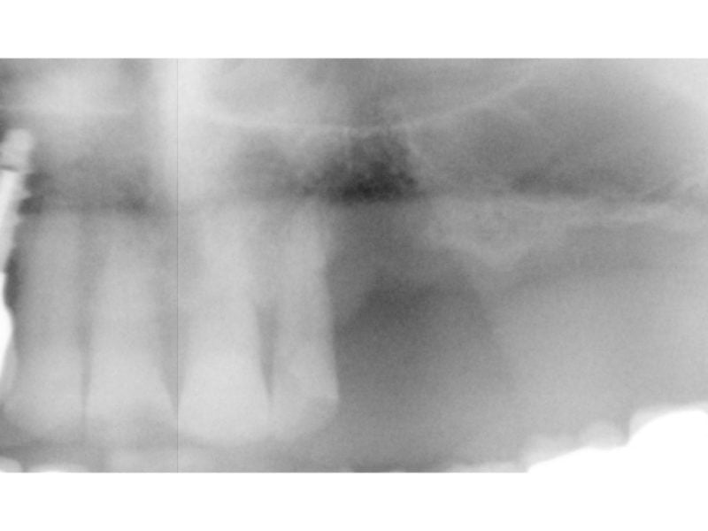 Safety Implant Membrane In Transcrestal Sinus Lift With Implant Insertion 2