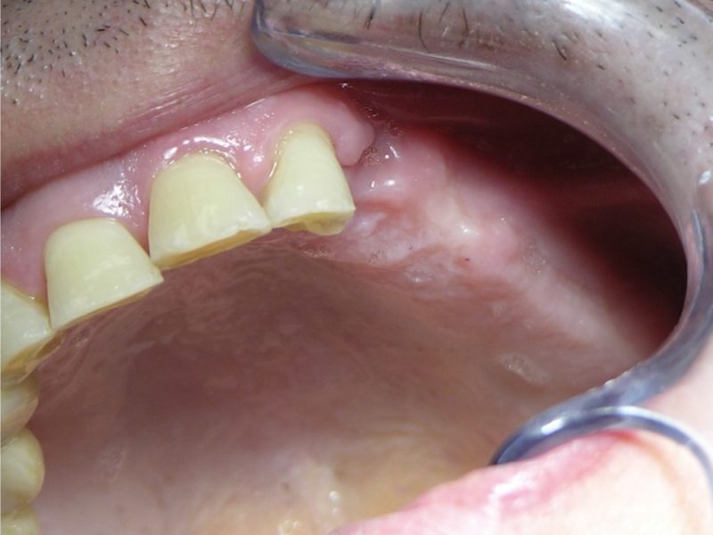 Safety Implant Membrane In Transcrestal Sinus Lift With Implant Insertion