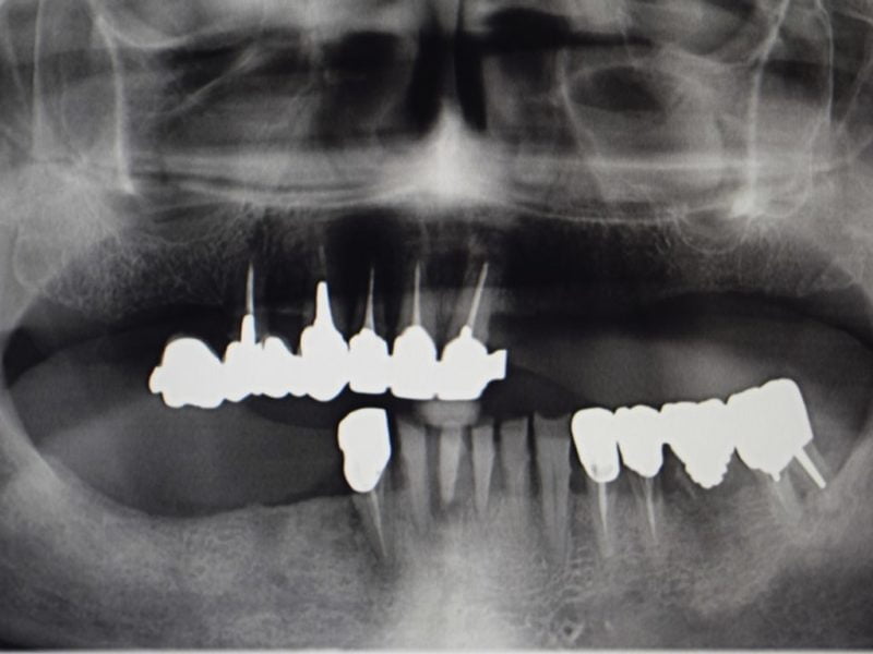 Stabilization Bar On Mua With Guide Arch 3