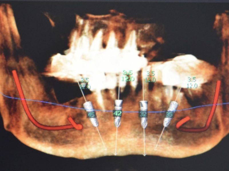 Stabilization Bar On Mua With Guide Arch 2
