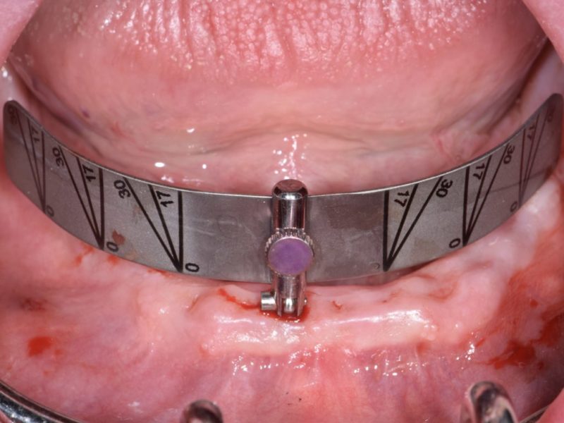 Stabilization Bar On Mua With Guide Arch