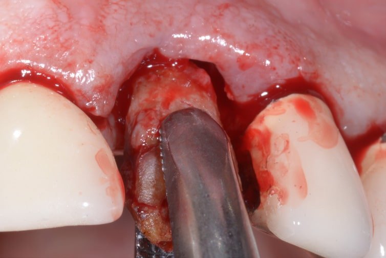 Aesthetic-functional Restoration In Frontal Post Extractive Site