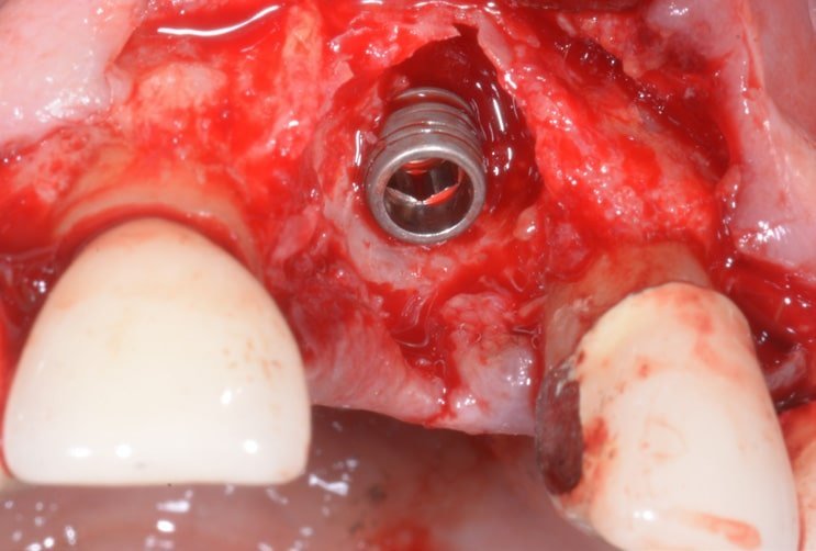 Aesthetic-functional Restoration In Frontal Post Extractive Site 2