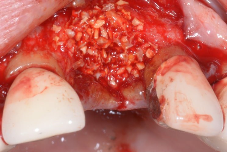 Aesthetic-functional Restoration In Frontal Post Extractive Site