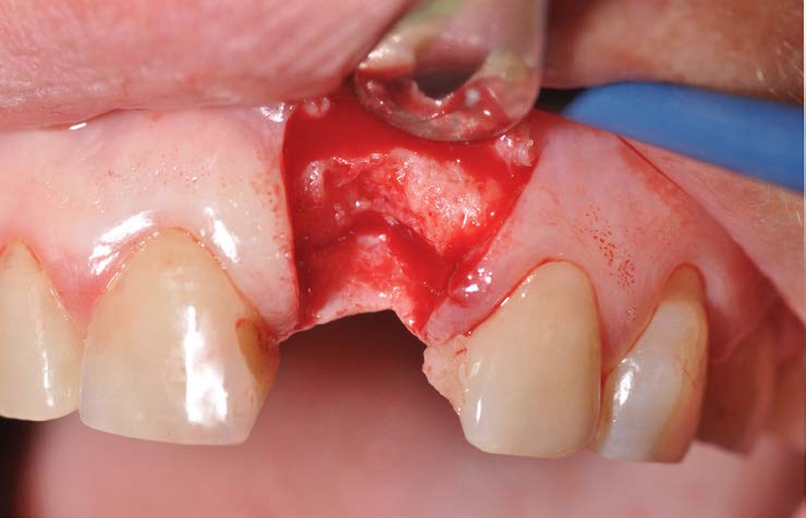 Soft And Hard Tissues Management In A Late Implant In The Aesthetic Area