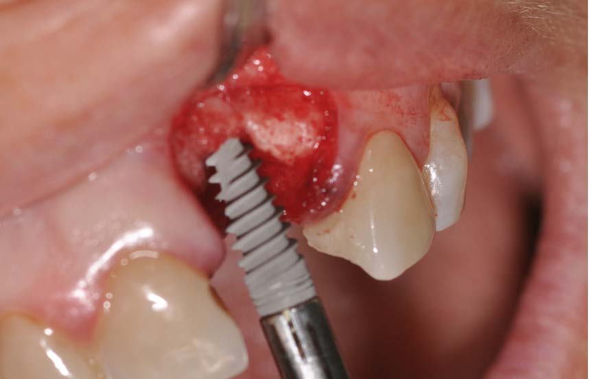 Soft And Hard Tissues Management In A Late Implant In The Aesthetic Area