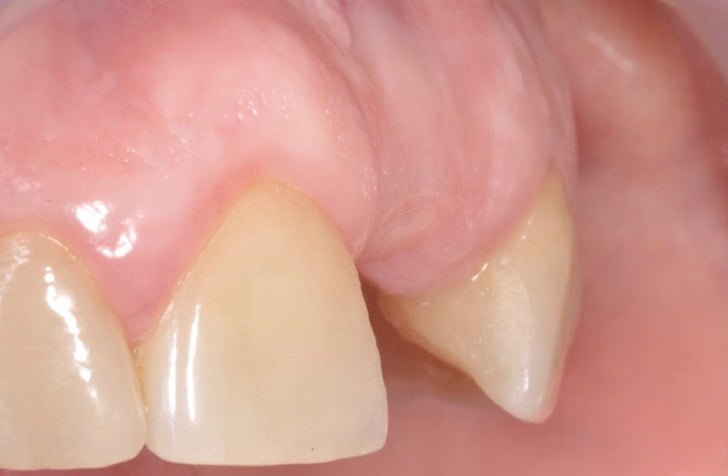 Soft And Hard Tissues Management In A Late Implant In The Aesthetic Area