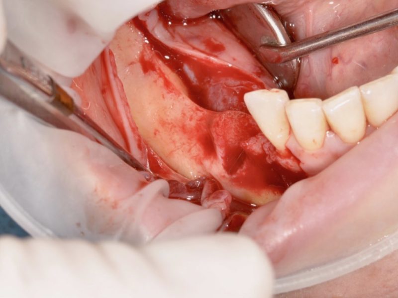 Restoration Of Vertical Bone Volume For Implant Insertion