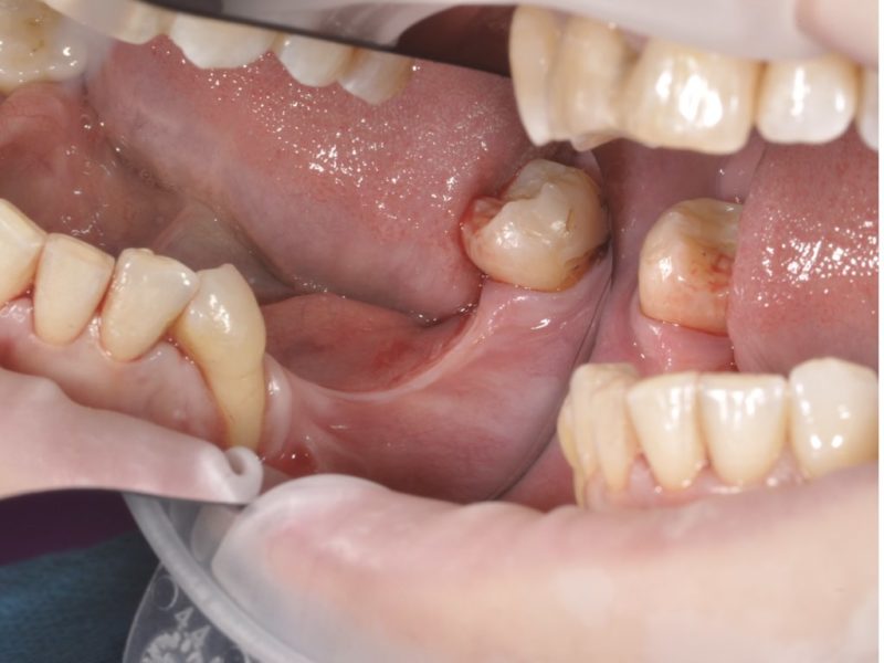 Restoration Of Vertical Bone Volume For Implant Insertion 2