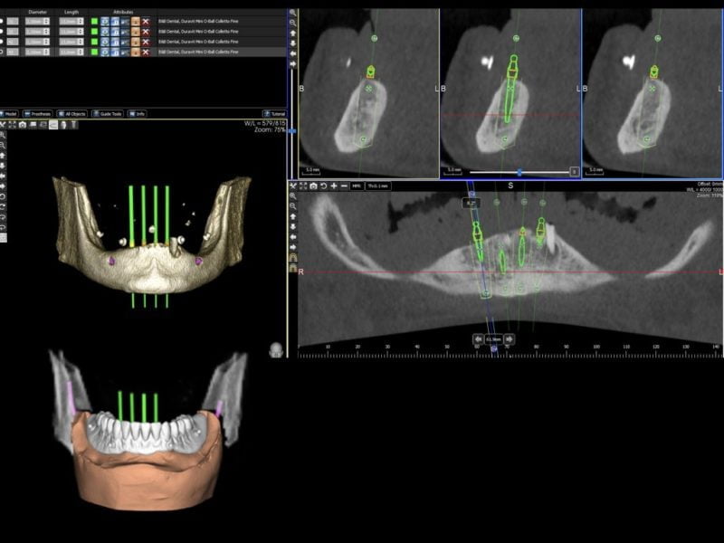 Mini Implants Guided Surgery