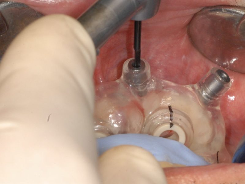 Guided Surgery Immediate Load With Use Of Previous Prosthesis
