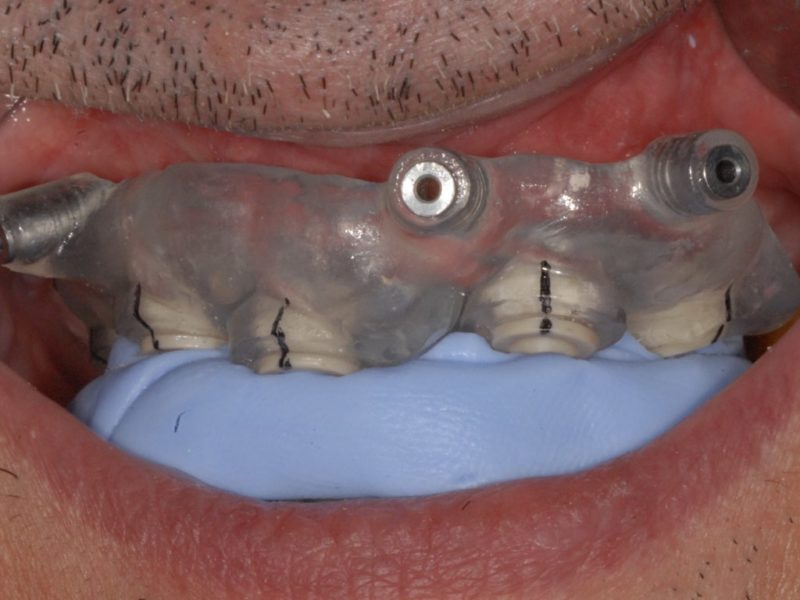 Guided Surgery Immediate Load With Use Of Previous Prosthesis