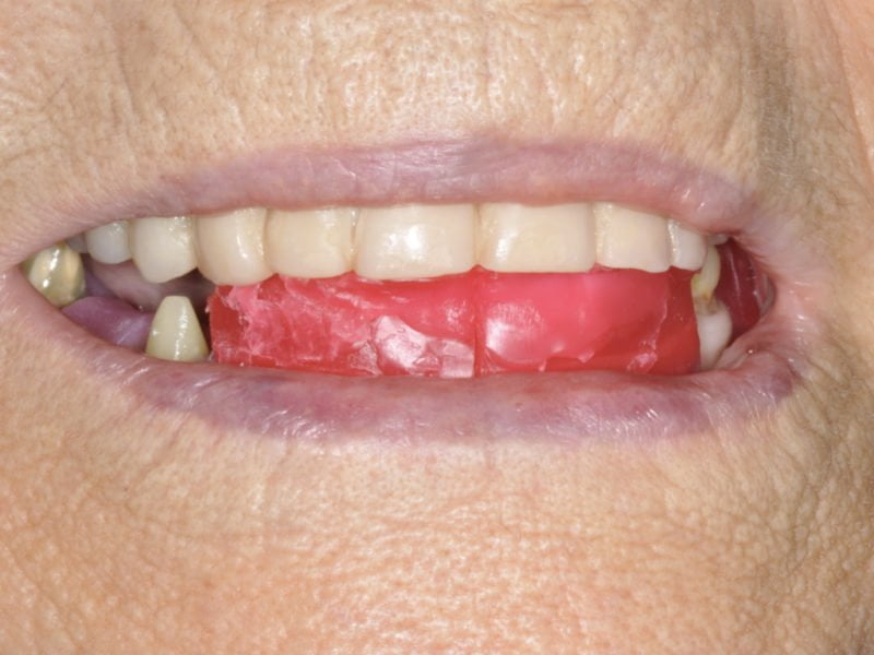 Guided Surgery With Immediate Load 2