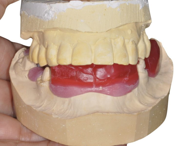 Guided Surgery With Immediate Load 3