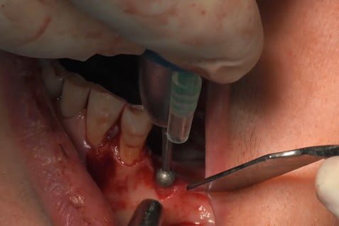 Bilateral Subperiosteal Customized Implants On Atrophic Mandible