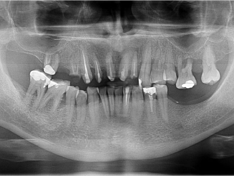 Bilateral Insertion Of Pterygoid Implants 3