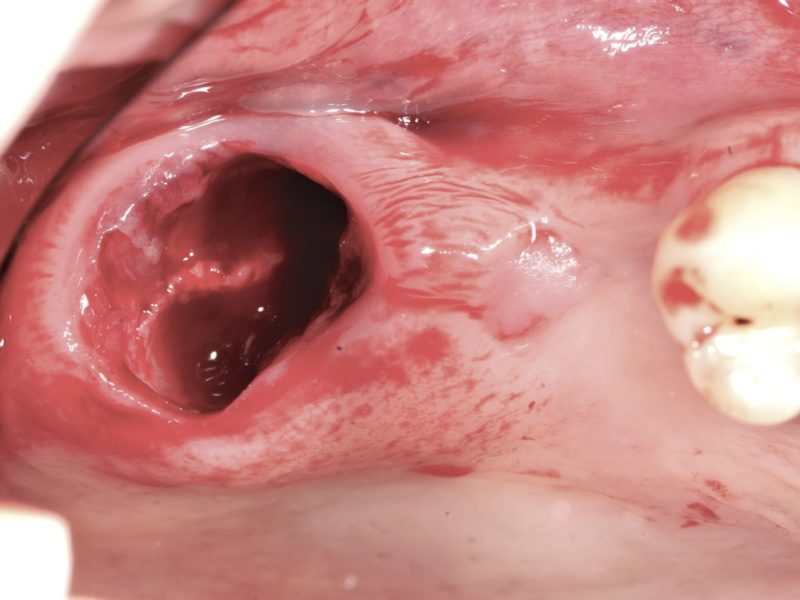 Bilateral Insertion Of Pterygoid Implants 2