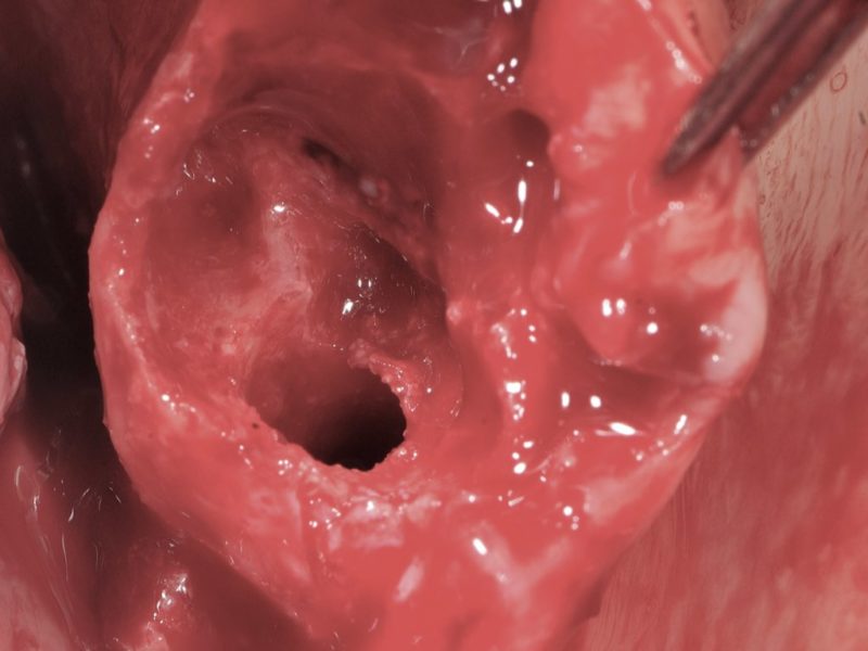 Bilateral Insertion Of Pterygoid Implants