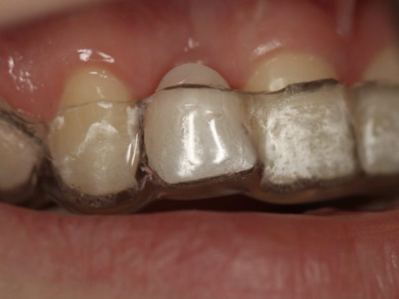 Implant Placement In Aesthetic Area With GBR