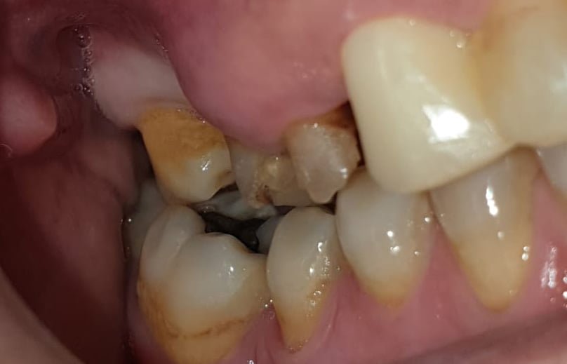 Therapeutic Treatment For Patient Maxillary Sinus Atrophy: Pterygoid Implants