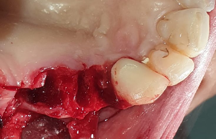 Therapeutic Treatment For Patient Maxillary Sinus Atrophy: Pterygoid Implants