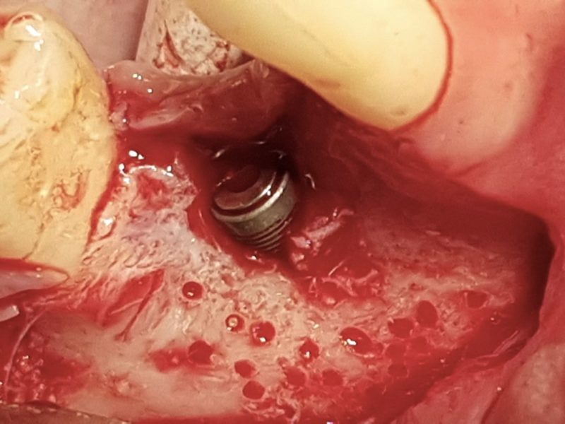 Bone Regeneration Material And Prf In Partially Exposed Implant Insertion