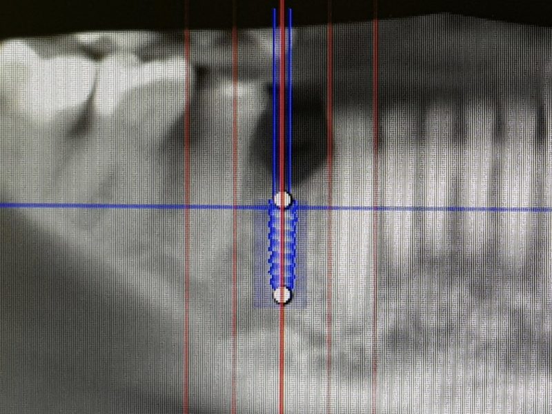Bone Regeneration Material And Prf In Partially Exposed Implant Insertion