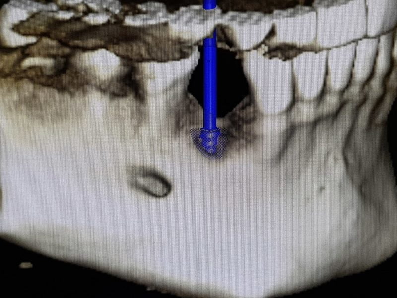 one Regeneration Material And Prf In Partially Exposed Implant Insertion