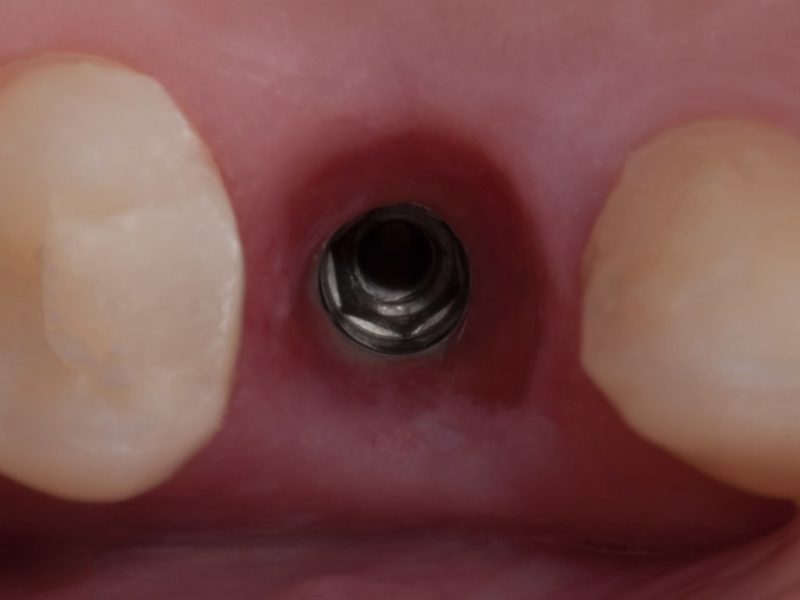 Peek Abutment Restoration 2