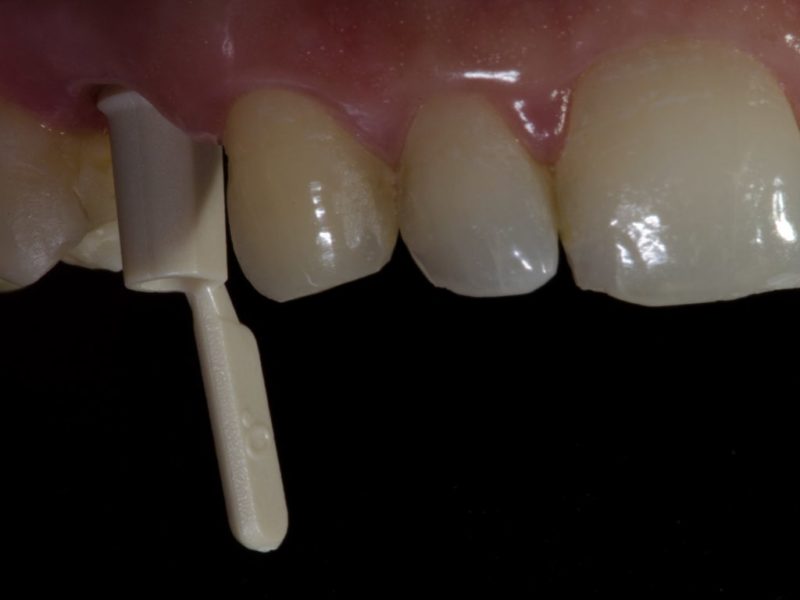 Peek Abutment Restoration