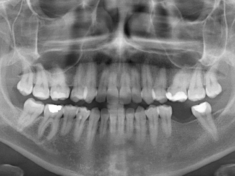 Single Implant With Angulated Peek Abutment